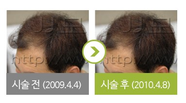 피나스테라이드 복용 전후사진 