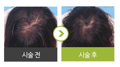여성형 탈모 (메조페시아 3개월 경과) 