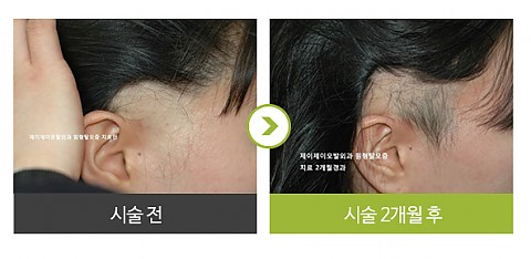 원형탈모 