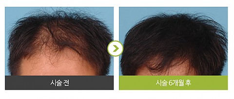 확산형 탈모 