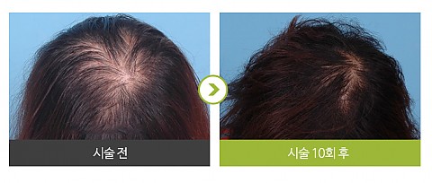 여성형 탈모 (메조페시아치료) 