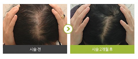 여성형탈모 (싸이토카인을 사용한 메조세라피) 