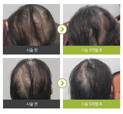 탈모치료 