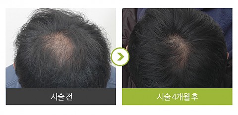 정수리 탈모 (메조페시아) 