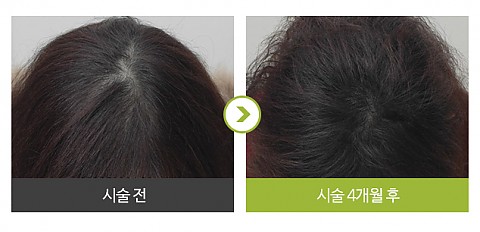 메조치료 