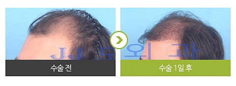 헤어라인 