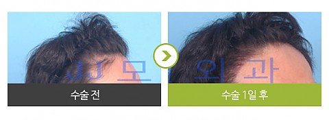 헤어라인 