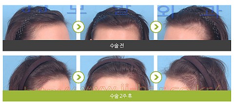 헤어라인교정 