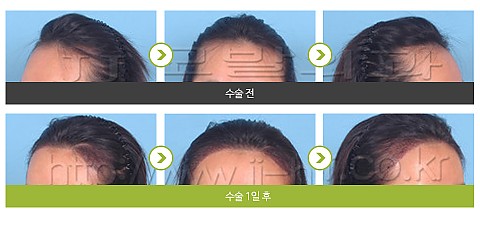 헤어라인 교정 (2000모) 