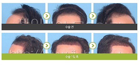 모발이식 (3000모) 