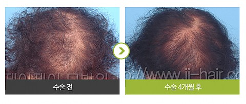 여성형 탈모 모발이식 (3000모) 