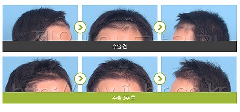모발이식 (2500모) 