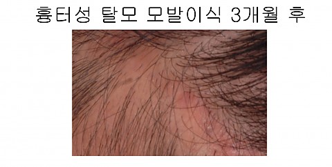 흉터성 탈모 모발이식 