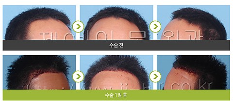 헤어라인 교정 (2500모) 