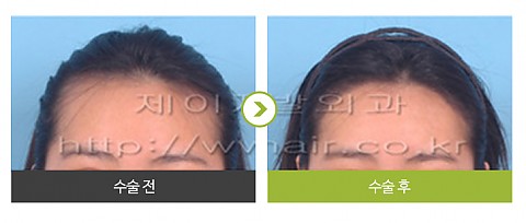 헤어라인교정 