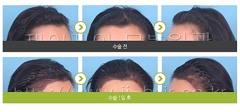 헤어라인교정 