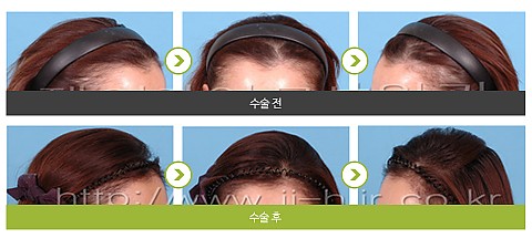 헤어라인교정 