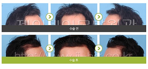 헤어라인 (2200모) 