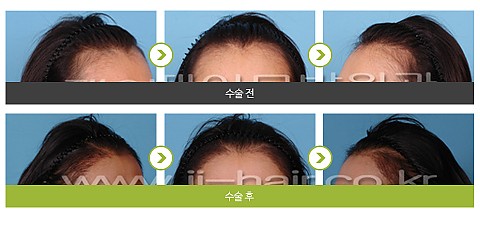 헤어라인교정 