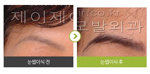 눈썹이식 