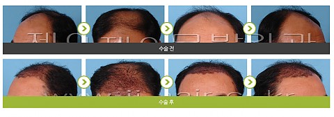 모발이식 (3500모) 