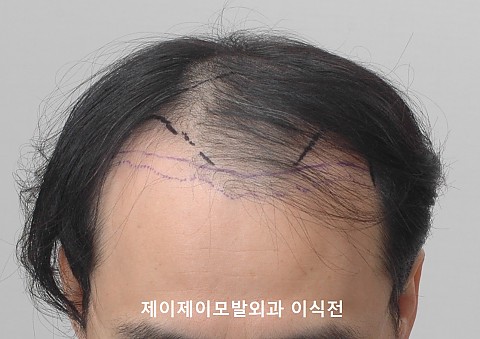 4500모 이식후 경과 