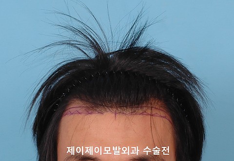 2차 모발이식 
