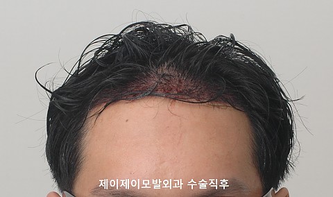 제이제이모발외과 이식후 경과 