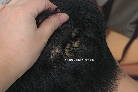 M자탈모 3500모 모발이식전후 