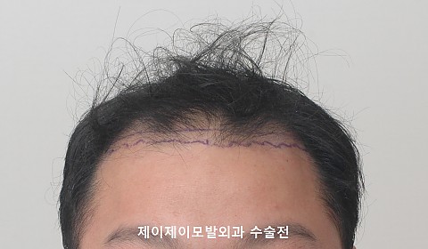 엠자탈모 정수리탈모 모발이식 