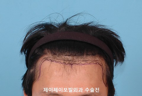 엠자탈모 정수리 탈모로 스트립방식 모발이식후 경과 