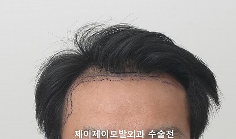 엠자탈모 정수리 탈모 4000모 모발이식 