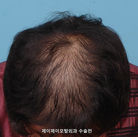 정수리 탈모 모발이식후 경과 