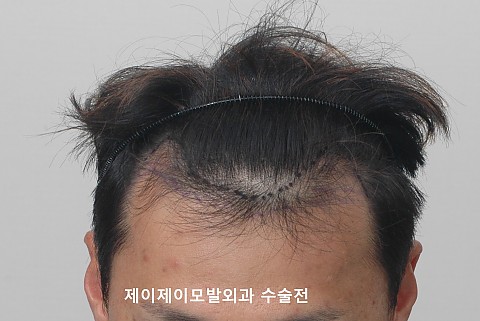엠자탈모 정수리 탈모 모발이식 