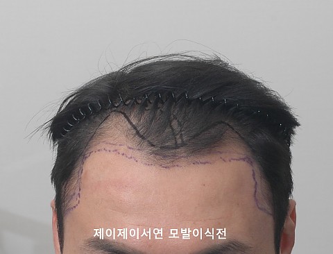 3500모 모발이식 6개월 경과 