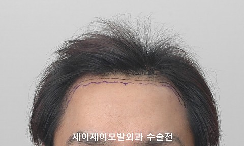 3500모 이식경과 
