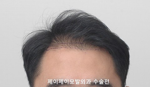 4000모 이식경과 