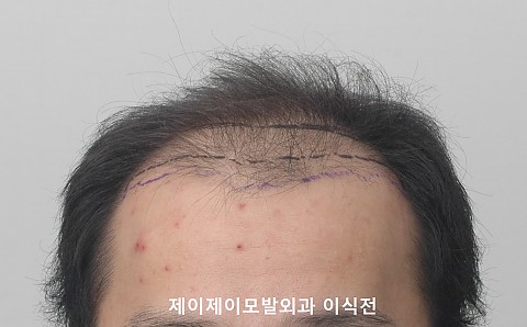5000모 이식경과 