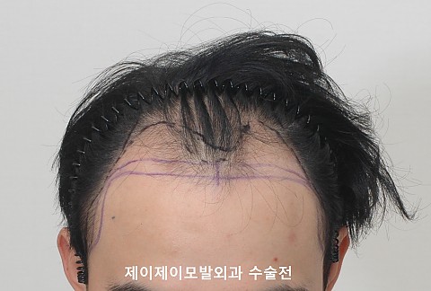 깊은 엠자탈모정수리탈모 