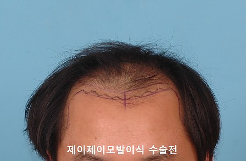 모발이식 5년3개월후 