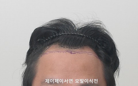 3000모 이식 