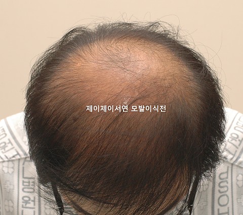 3000모 모발이식후 4년 경과 