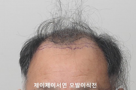 5000모 이식 
