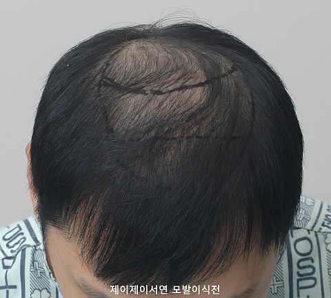 정수리 탈모 모발이식 
