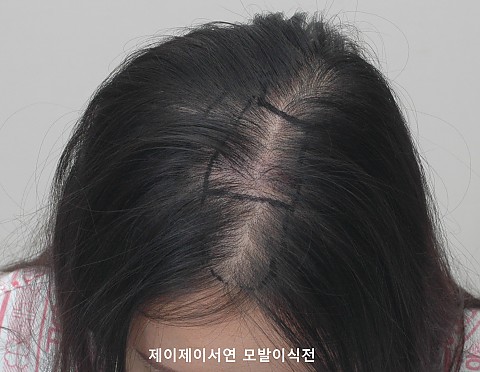 여성탈모 모발이식 