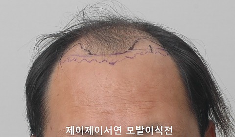 4500모 절개법  10개월경과 