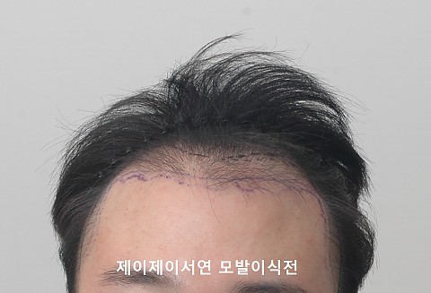 모발이식 전후 