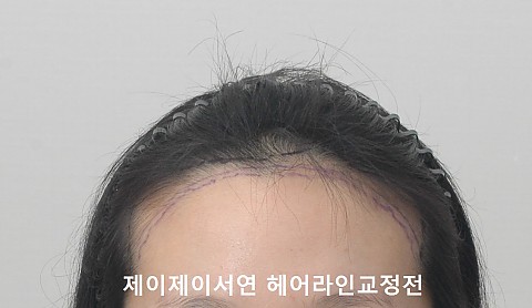헤어라인교정 