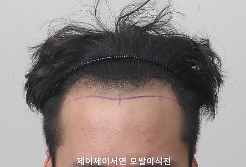 m자 탈모 