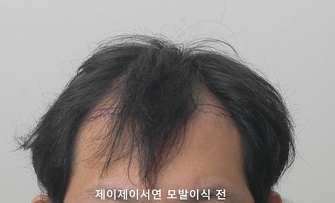 엠자탈모 정수리탈모 